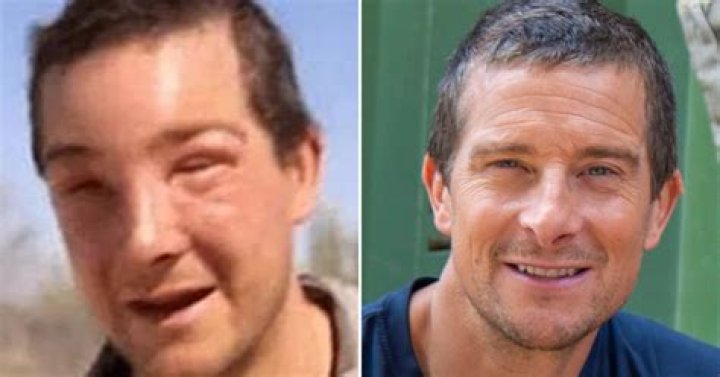 Bear Grylls suffers nearfatal bee sting and has to be saved by medics