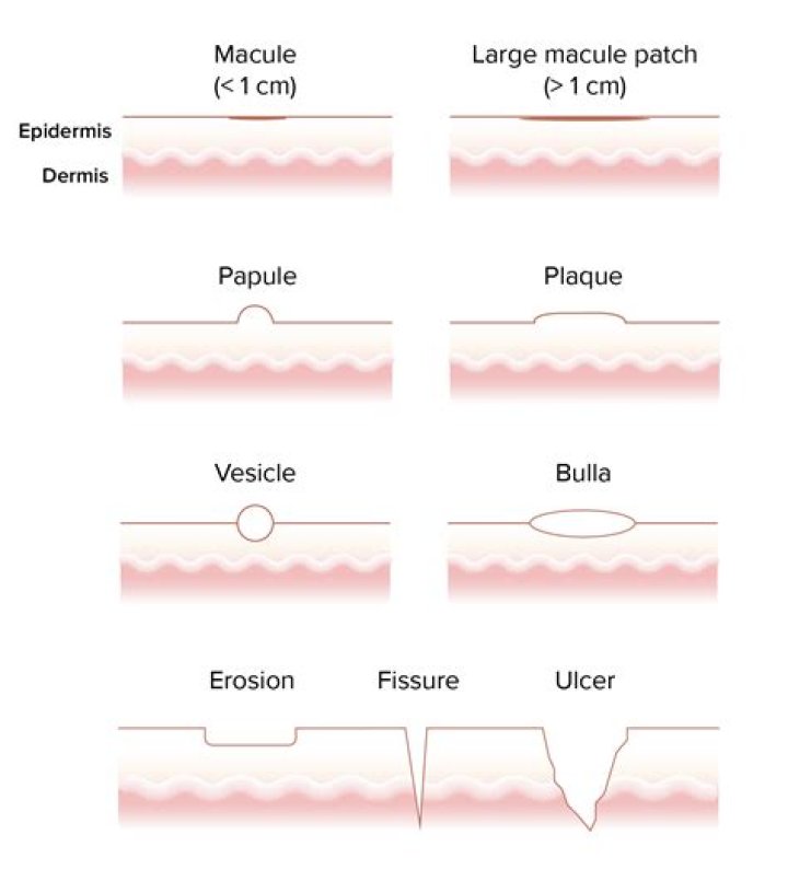 Macule Vs Papule