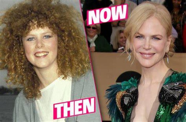 Nicole Kidman and her plastic surgery procedures