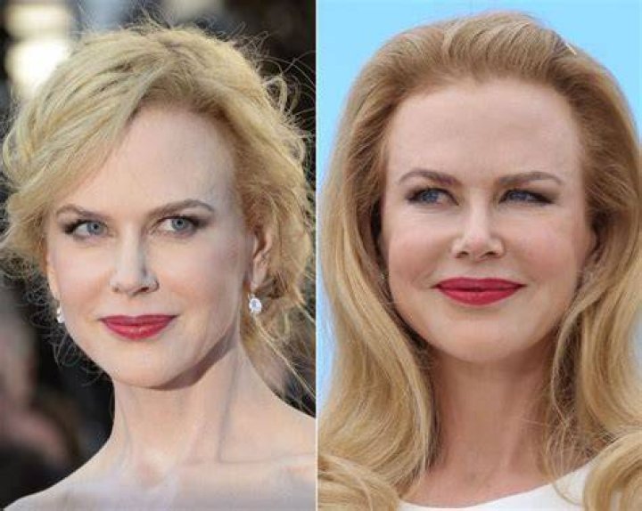 Nicole Kidman before and after plastic surgery (21) Celebrity plastic