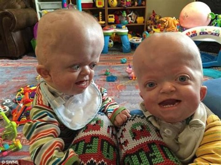 Twins with rare, disorder to sing the national anthem at EMCC